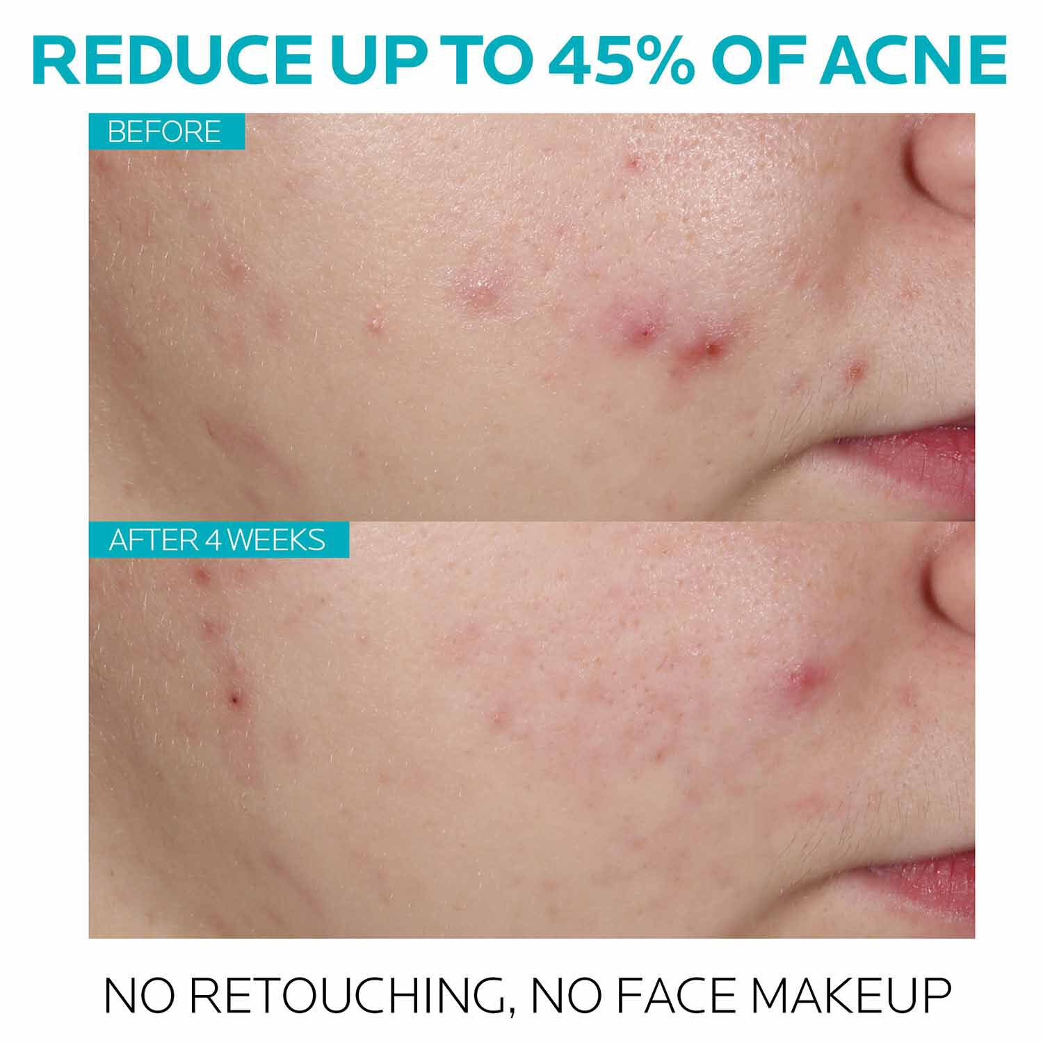 Effaclar Salicylic Acid Acne Treatment Serum